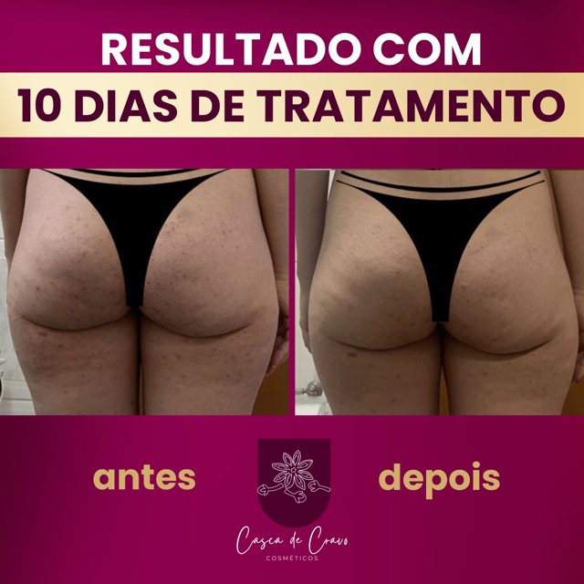 Tratamento Para Manchas de Foliculite Axilas Virilhas