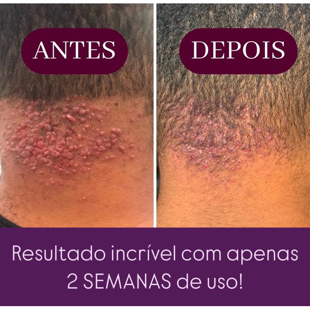 Tratamento Para Manchas de Foliculite Axilas Virilhas